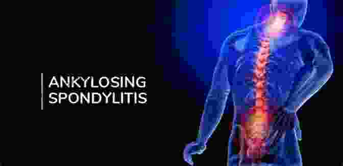 Ankylosing Spondylitis Morbus Bechterew Naturally Treated With Homeopathy And Ankylosing Spondylitis Morbus Bechterew Naturally Treated With Homeopathy And Schuessler Salts (homeopathic Cell Salts): A Homeopathic And Naturopathic Guide