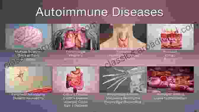 Autoimmune Response In Neuroimmunological Diseases A Primer Of Neuroimmunological Disease