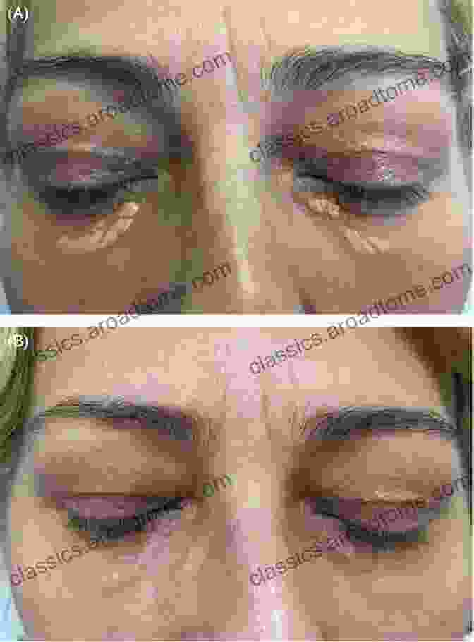 Plasma Treatment For Xanthelasma Xanthelasma An Aesthetic Affliction Of The Past