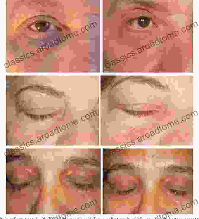 TCA Treatment For Xanthelasma Xanthelasma An Aesthetic Affliction Of The Past